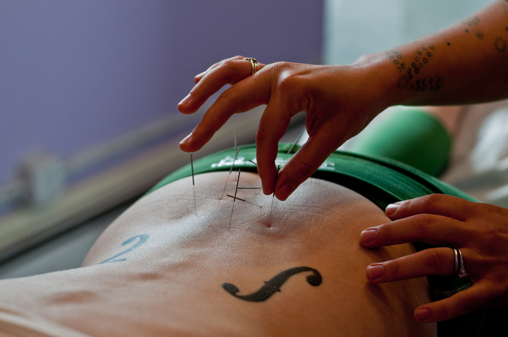 acupuncture for fertility